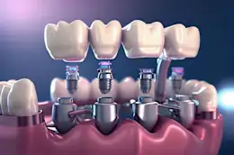 Here is the Real Cost of Full Mouth Dental Implants in 2024! (Take a Peek)